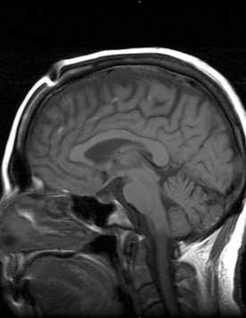 扎西卓瑪在接受泥丸道果法後的MRI照片。
