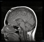 扎西卓瑪仁波且泥丸道果開頂後的 MRI 磁力共震圖