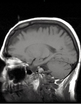 請注意在MRI掃描過開孔後能看到神識在離開扎西卓瑪的頭顱。